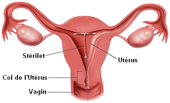 images_Sterilet-uterus.gif