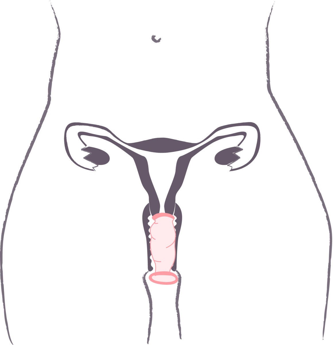 Preservatif-feminin.jpg