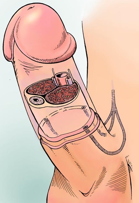 Erection.jpg